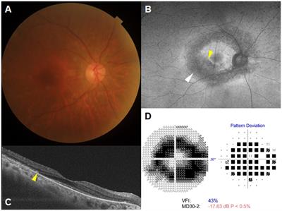 Causes and trends of late diagnosis in Korean patients with hydroxychloroquine retinopathy